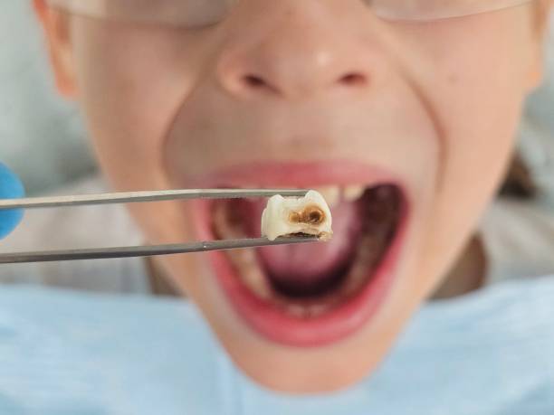 Best Emergency Treatment for Dental Infections or Abscesses in Rexland Acres, CA