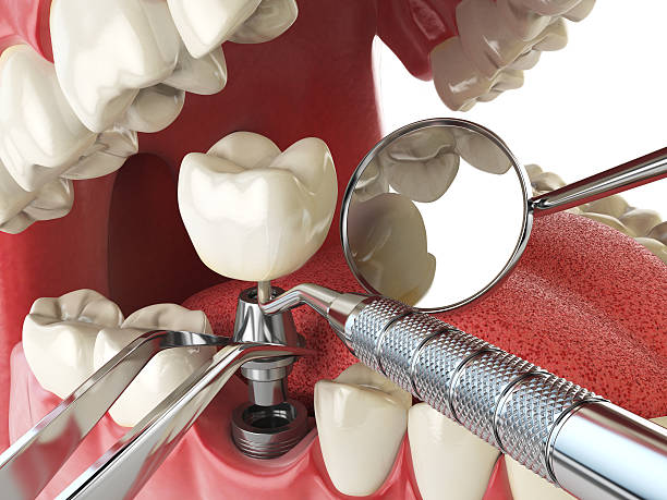 Best Emergency Tooth Extraction in Rexland Acres, CA